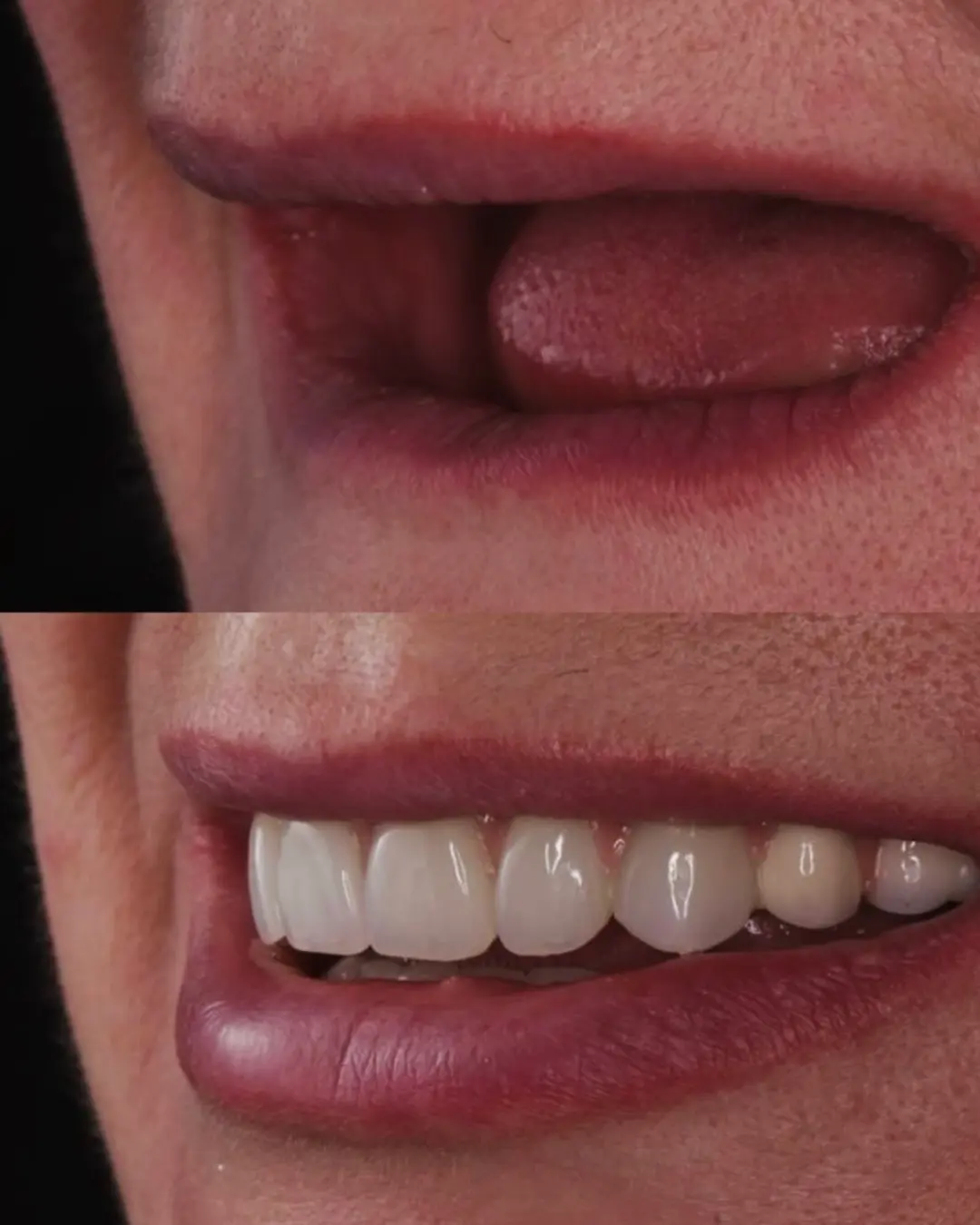 Dental implants before and after