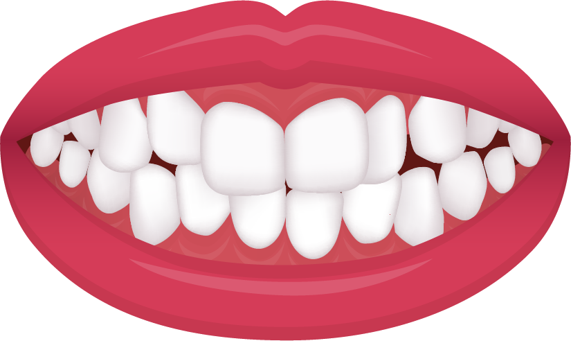 Crowded or overlapping teeth