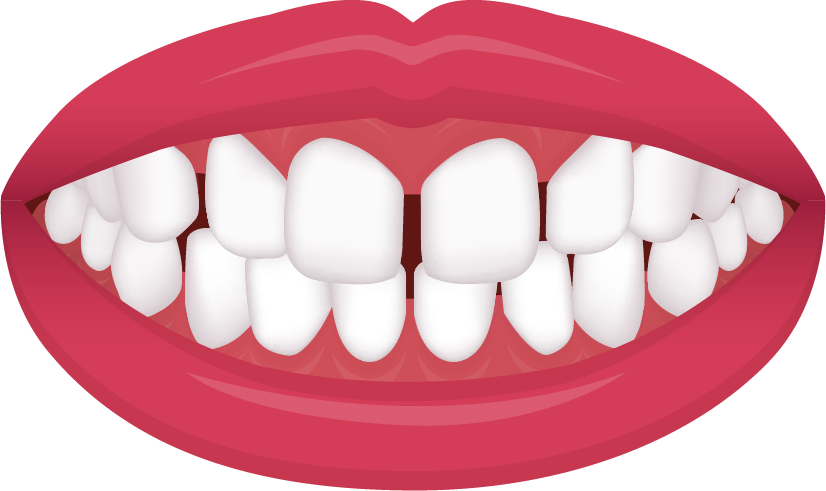 Gaps and spacing between teeth