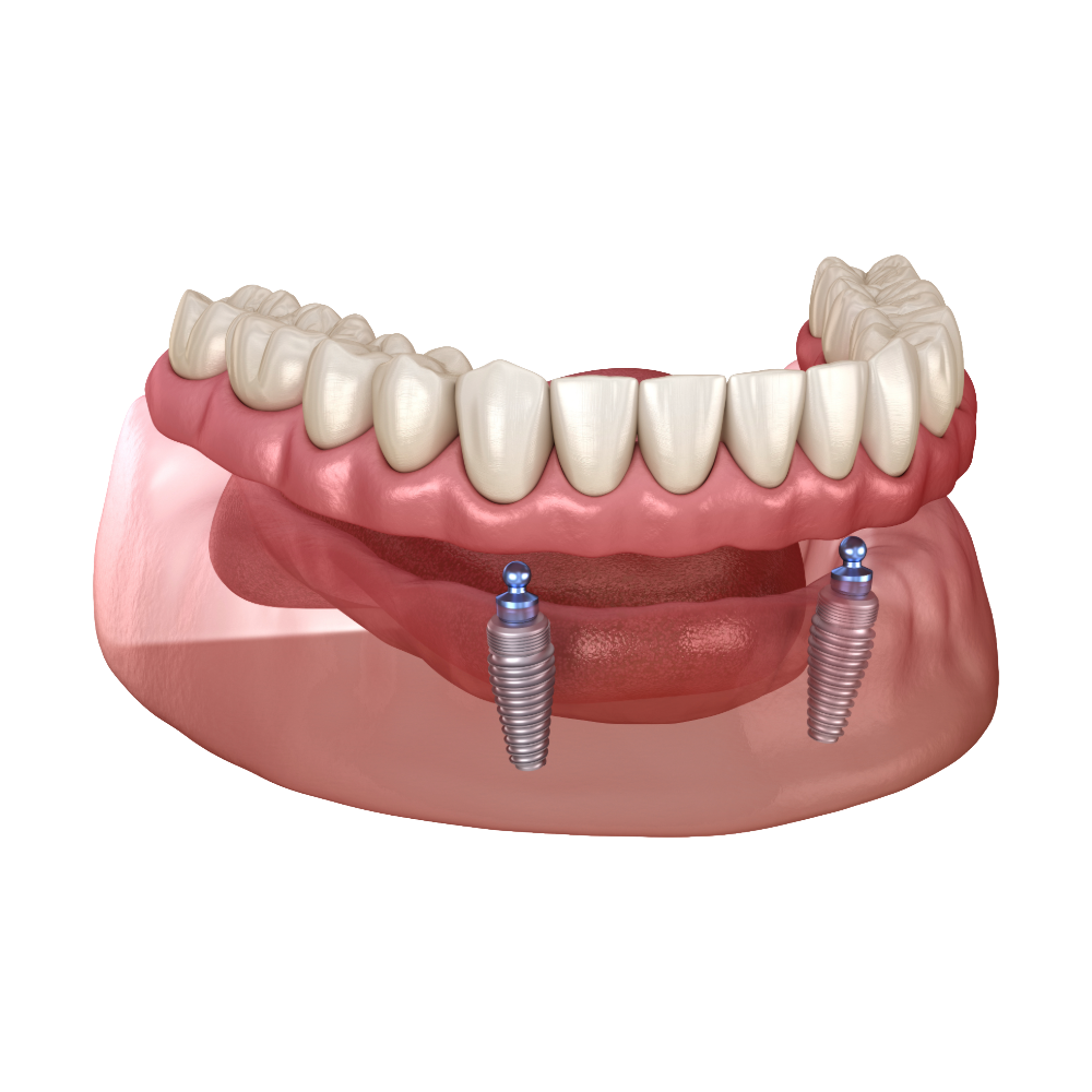 Implant-retained dentures