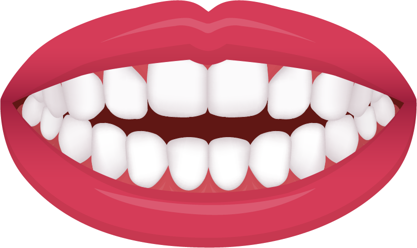 Open bite