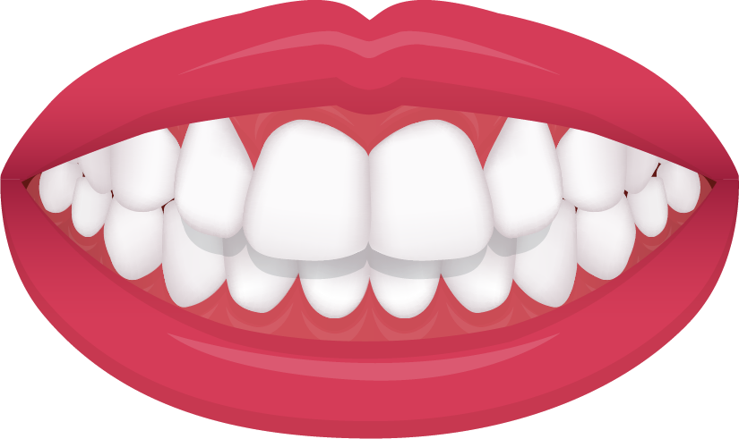 Overbite