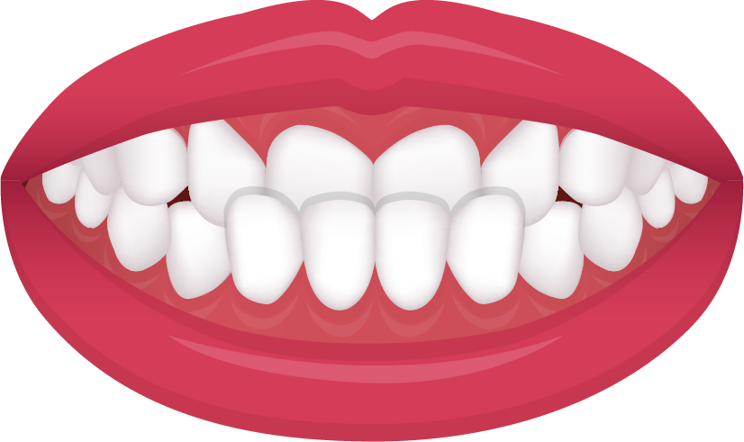 Underbite