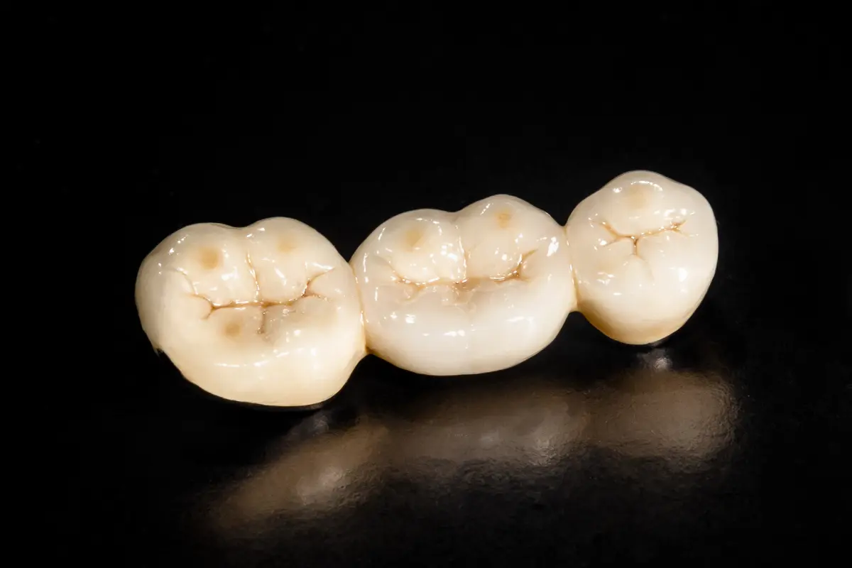 Dental Bridges