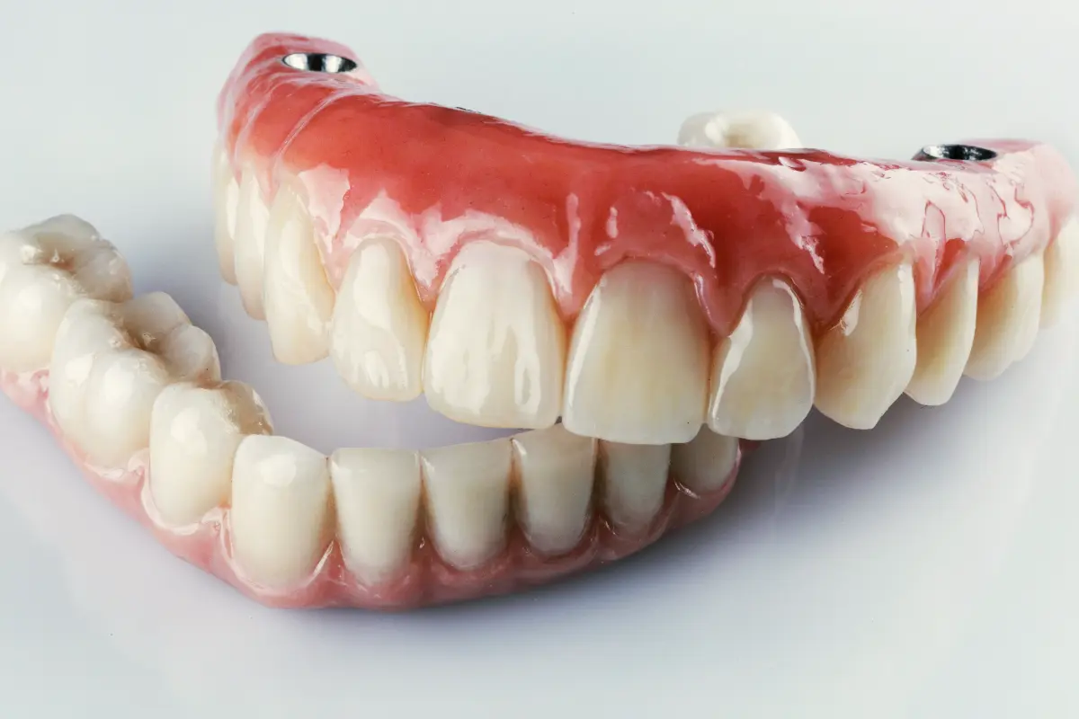 Implant-Retained Dentures