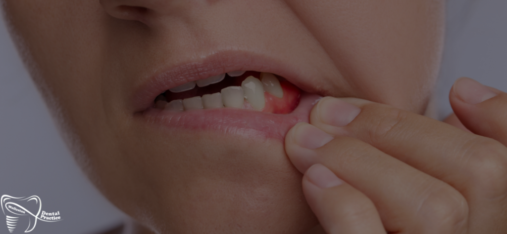 gum conditions