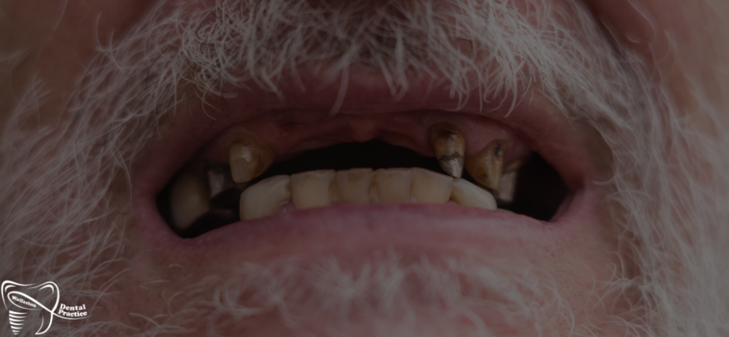 bad teeth - what is considered as bad teeth